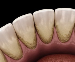 Zunächst nur als girlandenförmiges Band, kann der Zahnstein sich schließlich auch auf den Glattflächen der Zähne 